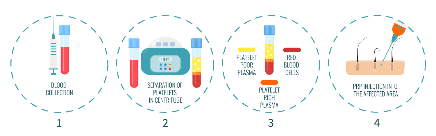 PRP Therapy