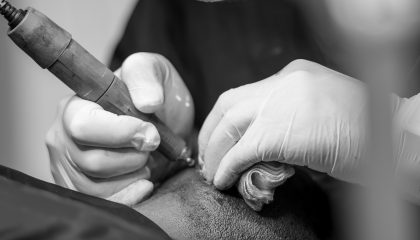 DHI Direct Hair Implantation Advanced Hair Transplant