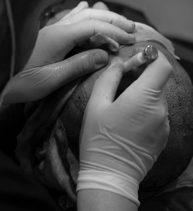 FUE Hair Transplants