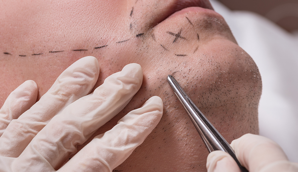 FUE beard Hair Transplant