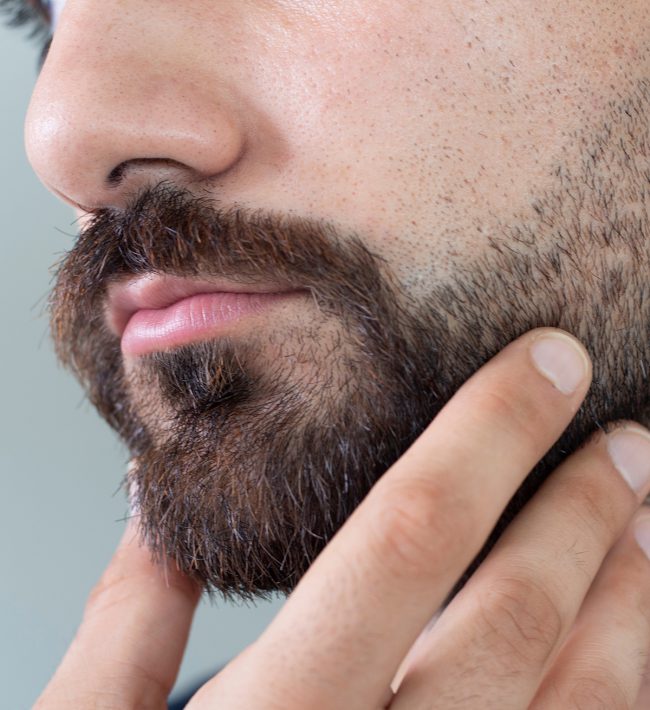 Male beard after hair transplant surgery
