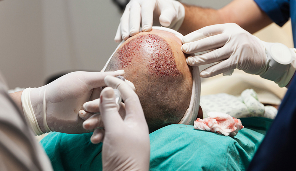 FUE Hair Transplants