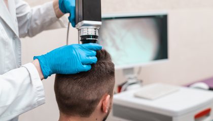 Trichotest – Microcamera scalp and hair analysis for personalised hair loss treatments