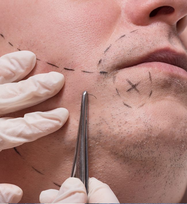 Beard Hair Transplants UK