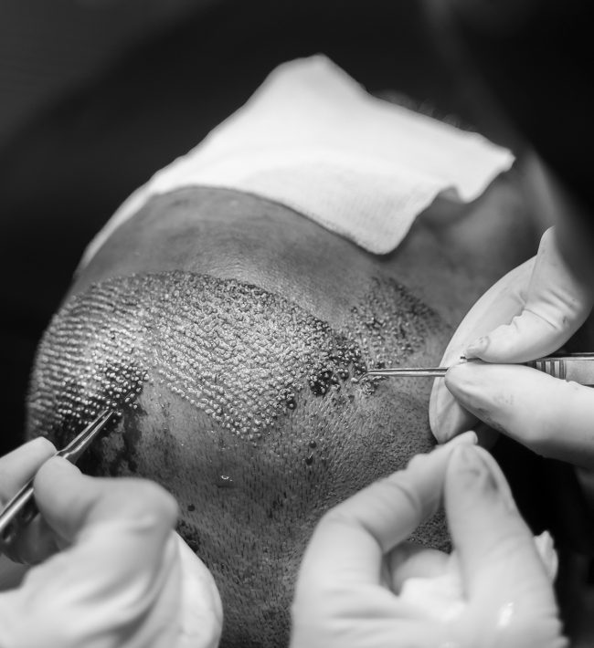 What results may you expect after your hair transplant surgery?