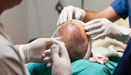 Micro sapphire FUE Hair Transplants (Follicular Unit Excision) for an affordable price