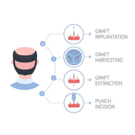 Hair transplants (Pay online)