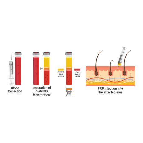 PRP therapy (Pay online)